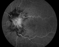 Angiographie à la fluorescéine temps précoce OG