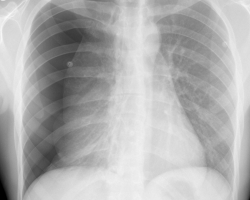 RX PNEUMOTHORAX.jpg