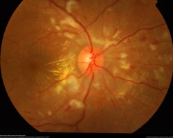 Fond d'oeil OD