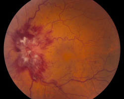 Fond d'oeil OG