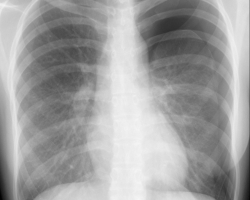 RX PNEUMOTHORAX G.jpg