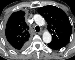mesotheliome tdm.jpg
