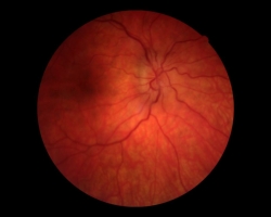 Fond d'oeil OD