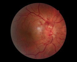 Fond d'oeil OD