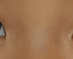 Chalazion de l'oeil droit
