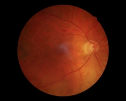 Fond d'oeil OD