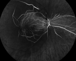 Angiographie à la fluorescéine OD 1 min