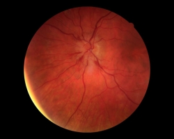 Fond d'oeil OG