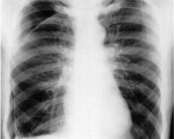 Pneumothorax.png