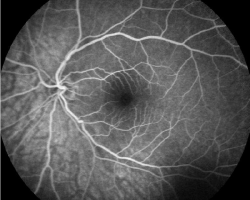 Angiographie Fluorescéine OG (2)