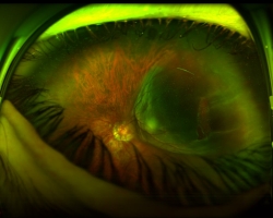 Fond d'oeil OG (rétinophotographie optomap)