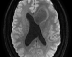 IRM Ax Séquences en diffusion B1000.PNG