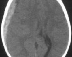 hematomessdural.png