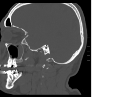 TDM sagittal.png