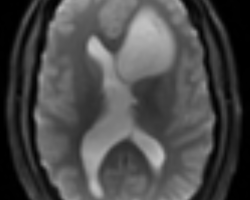 IRM Ax perfusion.PNG