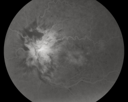 Angiographie à la fluorescéine temps tardif OG