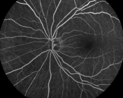 Angiographie à la fluorescéine OG 1 min