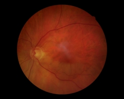 Fon d'oeil OG