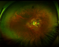 Fond d'oeil OD (rétinophotographie optomap)