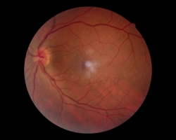 Fond d'oeil OG