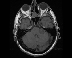 neurinome du VIII (1).jpg
