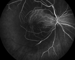 Angiographie à la fluorescéine OD 2min