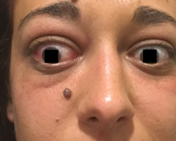 exophtalmie.png
