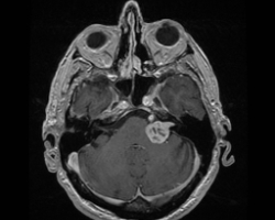 neurinome du VIII (2).jpg