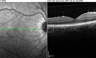 Rétinopathie diabétique – Tomographie en Cohérence Optique (OCT)