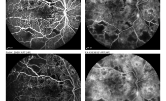 Rétinopathie diabétique – Angiographie à la fluorescéine (AF)